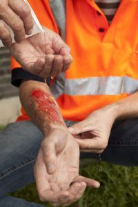 Burn injury at workplace