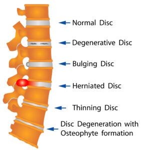 Herniated Disc Injury